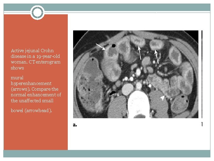 Active jejunal Crohn disease in a 19 -year-old woman. CT enterogram shows mural hyperenhancement