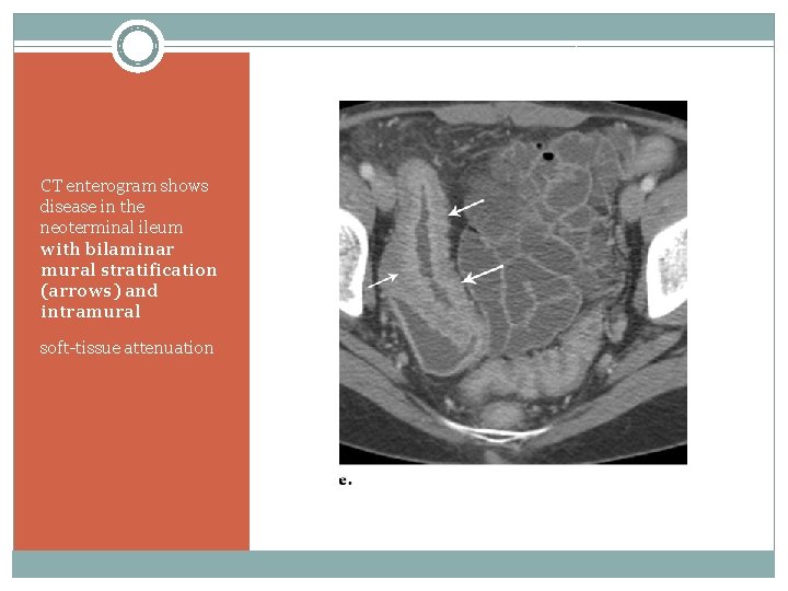 CT enterogram shows disease in the neoterminal ileum with bilaminar mural stratification (arrows) and