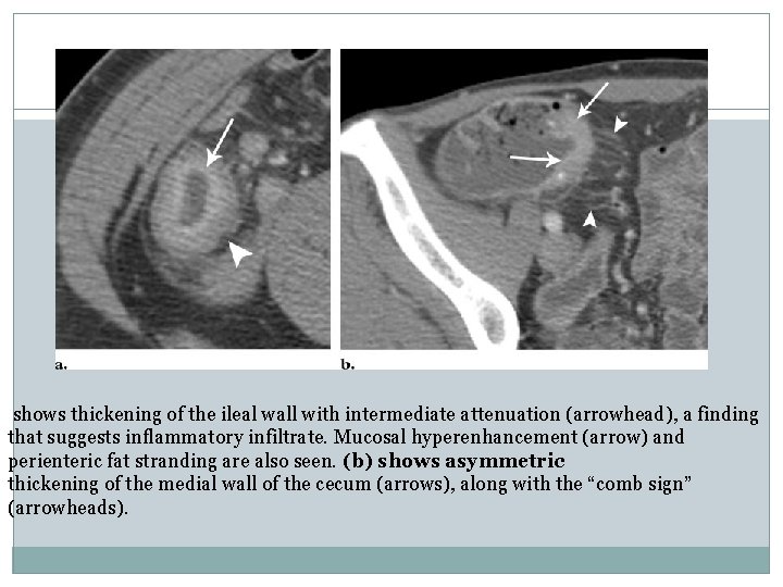 shows thickening of the ileal wall with intermediate attenuation (arrowhead), a finding that suggests