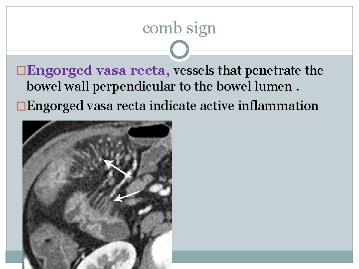 comb sign �Engorged vasa recta, vessels that penetrate the bowel wall perpendicular to the