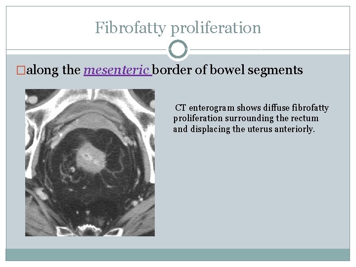 Fibrofatty proliferation �along the mesenteric border of bowel segments CT enterogram shows diffuse fibrofatty