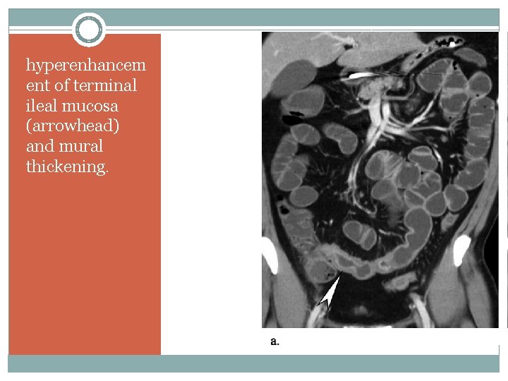 hyperenhancem ent of terminal ileal mucosa (arrowhead) and mural thickening. 