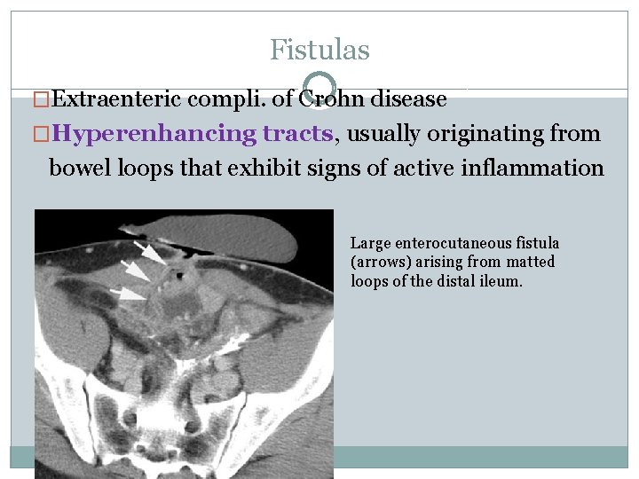 Fistulas �Extraenteric compli. of Crohn disease �Hyperenhancing tracts, usually originating from bowel loops that