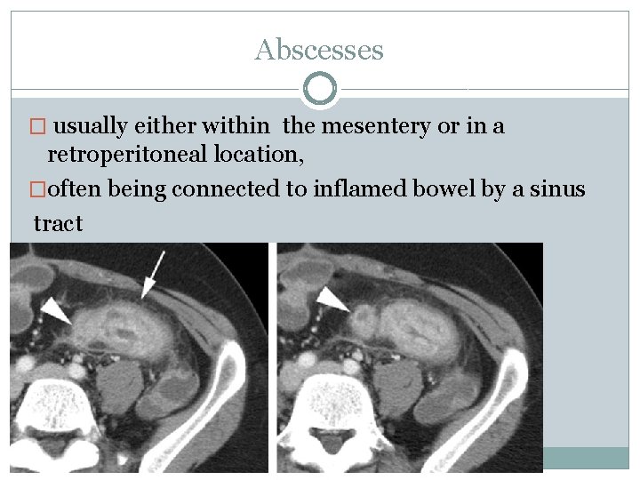 Abscesses � usually either within the mesentery or in a retroperitoneal location, �often being