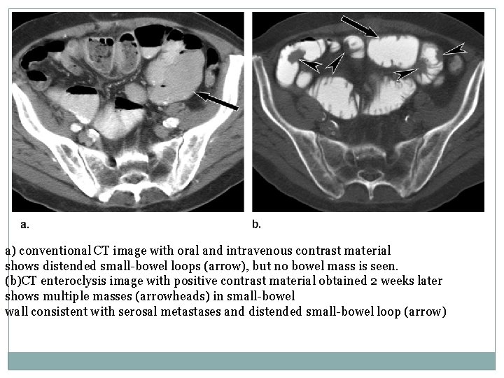 a) conventional CT image with oral and intravenous contrast material shows distended small-bowel loops