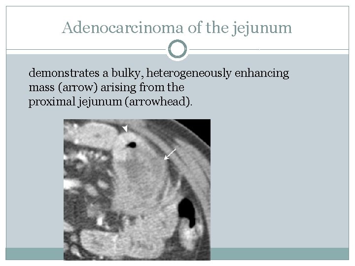 Adenocarcinoma of the jejunum demonstrates a bulky, heterogeneously enhancing mass (arrow) arising from the