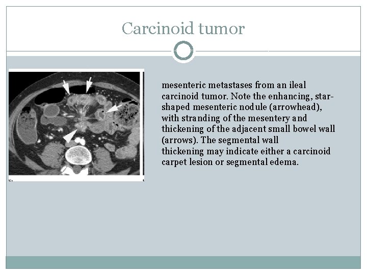 Carcinoid tumor mesenteric metastases from an ileal carcinoid tumor. Note the enhancing, starshaped mesenteric