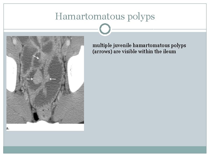 Hamartomatous polyps multiple juvenile hamartomatous polyps (arrows) are visible within the ileum 