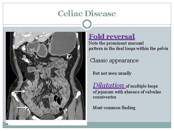 Celiac Disease Fold reversal. Note the prominent mucosal pattern in the ileal loops within