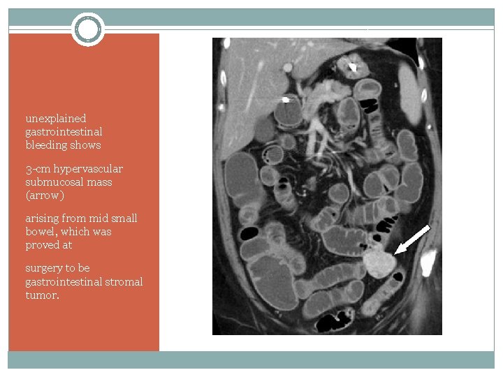 unexplained gastrointestinal bleeding shows 3 -cm hypervascular submucosal mass (arrow) arising from mid small