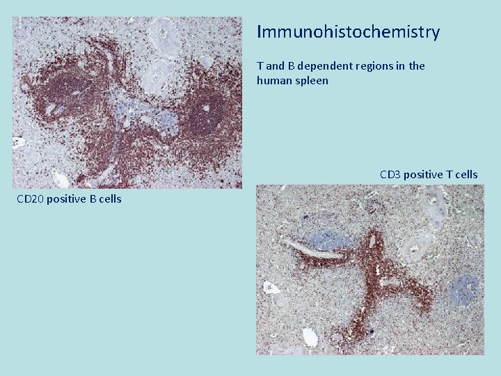 Immunohistochemistry T and B dependent regions in the human spleen CD 3 positive T