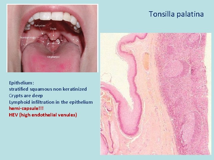 Tonsilla palatina Epithelium: stratified squamous non keratinized Crypts are deep Lymphoid infiltration in the