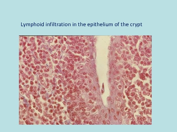 Lymphoid infiltration in the epithelium of the crypt 