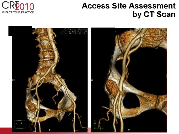 Access Site Assessment by CT Scan 