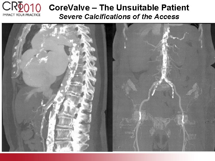 Core. Valve – The Unsuitable Patient Severe Calcifications of the Access 