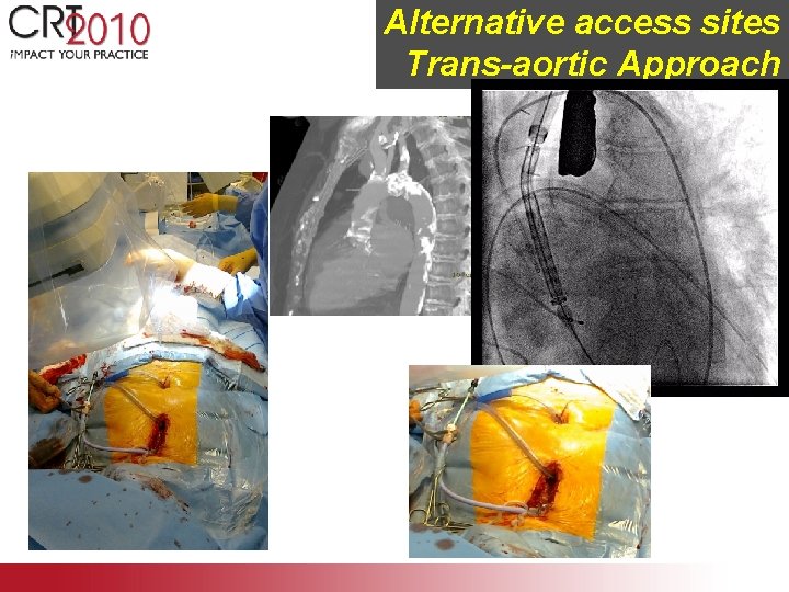 Alternative access sites Trans-aortic Approach 
