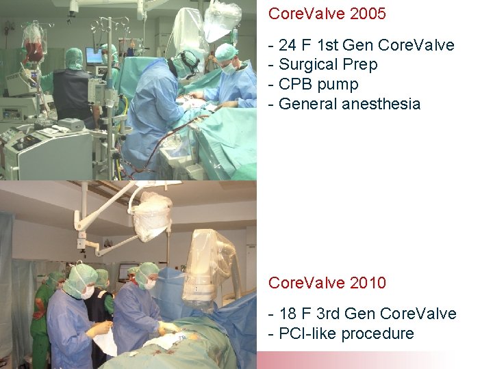 Core. Valve 2005 - 24 F 1 st Gen Core. Valve - Surgical Prep
