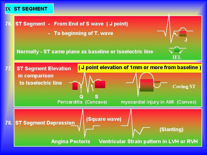 IX ST SEGMENT 76. ST Segment - From End of S wave ( J