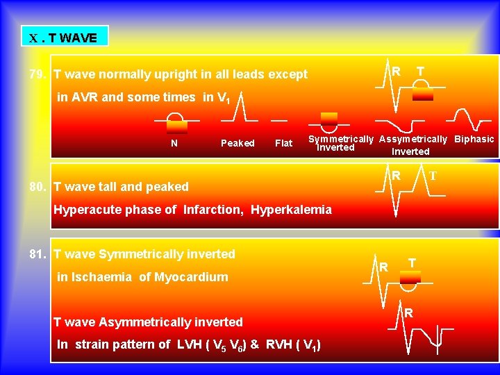 X. T WAVE R 79. T wave normally upright in all leads except T