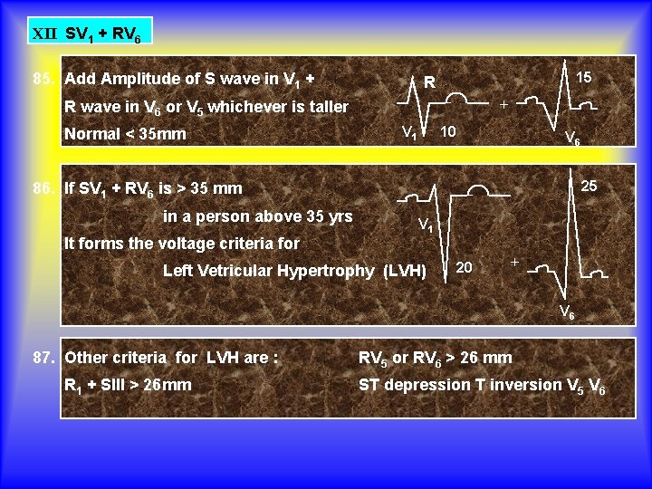 XII SV 1 + RV 6 85. Add Amplitude of S wave in V
