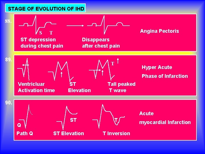 STAGE OF EVOLUTION OF IHD 88. Angina Pectoris S T ST depression during chest