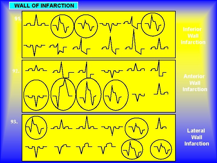 WALL OF INFARCTION 91. Inferior Wall Infarction 92. Anterior Wall Infarction 93. Lateral Wall