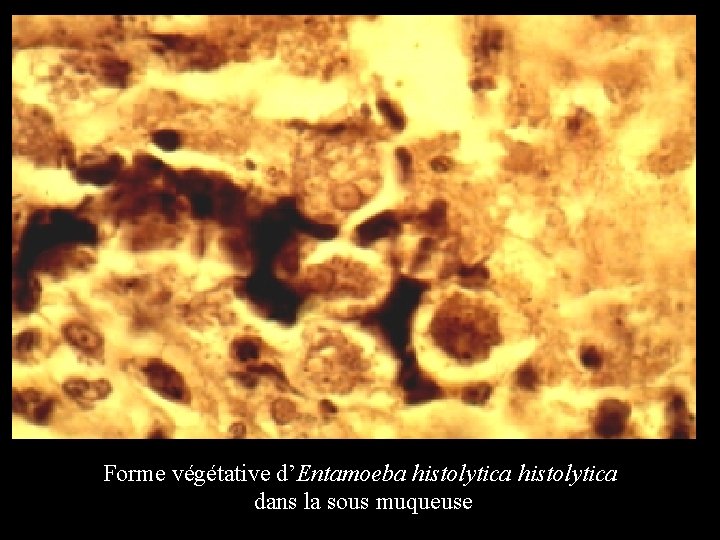 Forme végétative d’Entamoeba histolytica dans la sous muqueuse 
