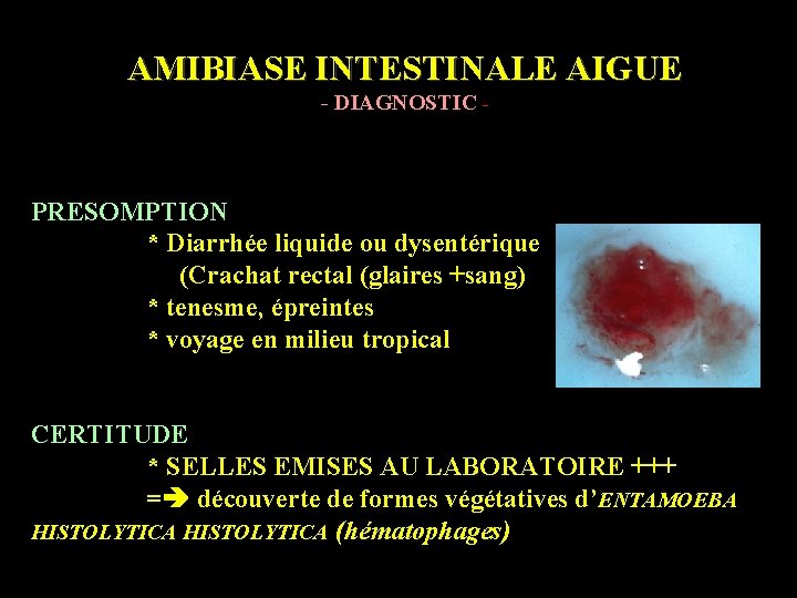 AMIBIASE INTESTINALE AIGUE - DIAGNOSTIC - PRESOMPTION * Diarrhée liquide ou dysentérique (Crachat rectal