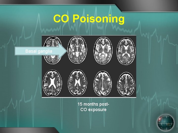 CO Poisoning Basal ganglia 15 months post. CO exposure 