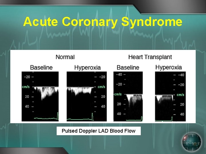 Acute Coronary Syndrome Pulsed Doppler LAD Blood Flow 