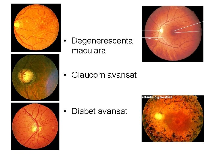  • Degenerescenta maculara • Glaucom avansat • Diabet avansat 