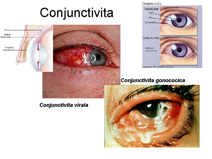 Conjunctivita gonococica Conjunctivita virala 