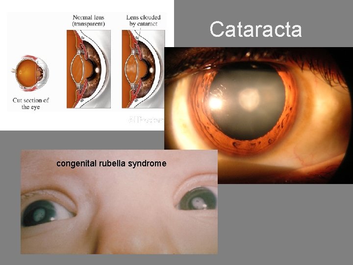 Cataracta congenital rubella syndrome 
