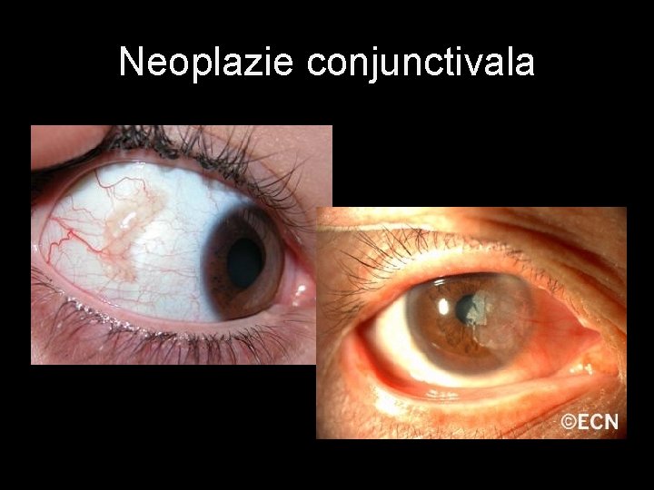 Neoplazie conjunctivala 