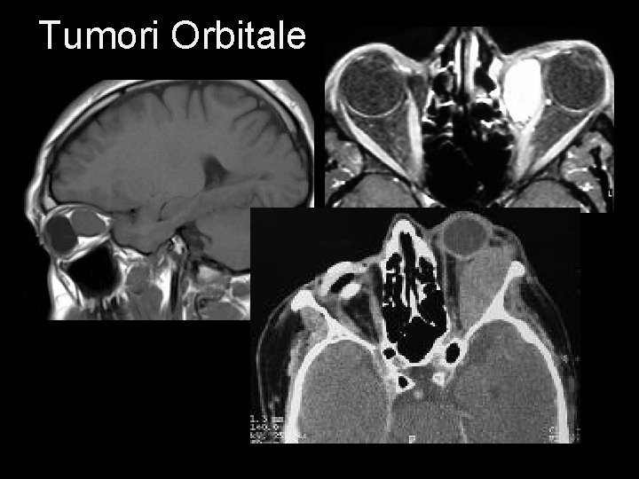 Tumori Orbitale 