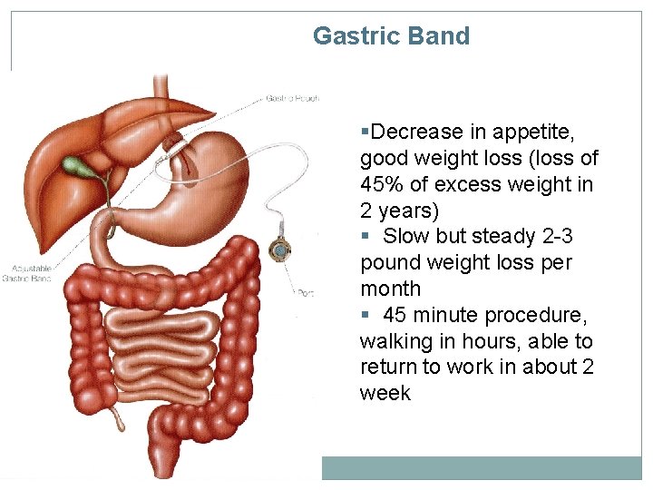 Gastric Band §Decrease in appetite, good weight loss (loss of 45% of excess weight