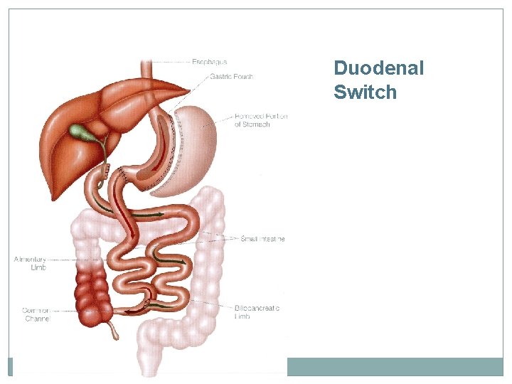 Duodenal Switch 