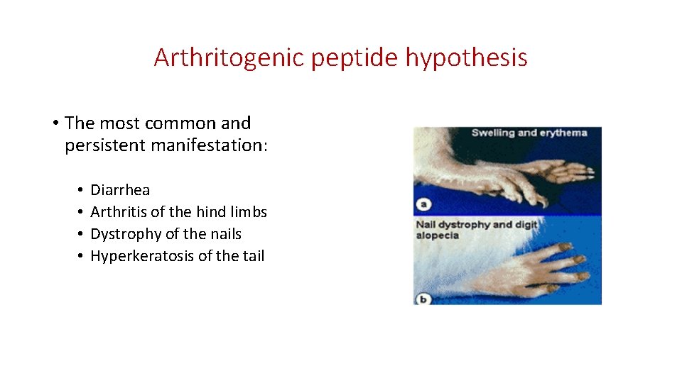 Arthritogenic peptide hypothesis • The most common and persistent manifestation: • • Diarrhea Arthritis