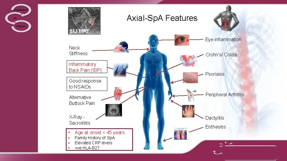 Axial-Sp. A Features SIJ MRI Eye inflammation Neck Stiffness Inflammatory Back Pain (IBP) Crohn’s/