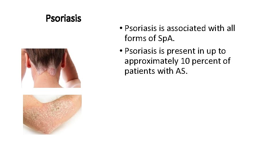 Psoriasis • Psoriasis is associated with all forms of Sp. A. • Psoriasis is