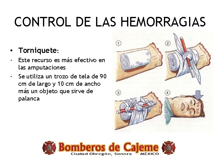 CONTROL DE LAS HEMORRAGIAS • Torniquete: - Este recurso es más efectivo en las