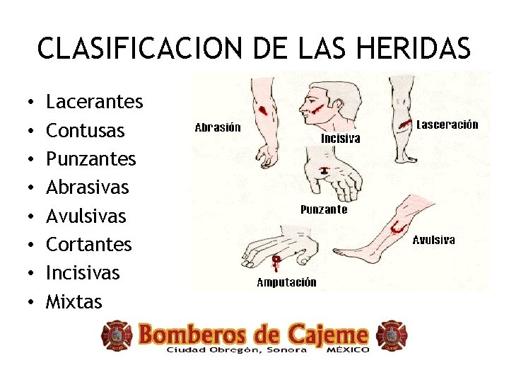 CLASIFICACION DE LAS HERIDAS • • Lacerantes Contusas Punzantes Abrasivas Avulsivas Cortantes Incisivas Mixtas