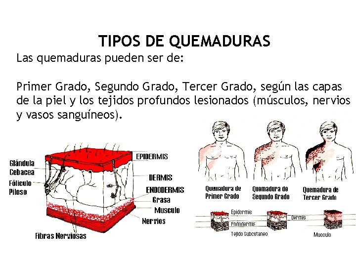 TIPOS DE QUEMADURAS Las quemaduras pueden ser de: Primer Grado, Segundo Grado, Tercer Grado,