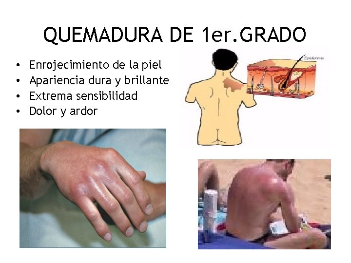 QUEMADURA DE 1 er. GRADO • • Enrojecimiento de la piel Apariencia dura y