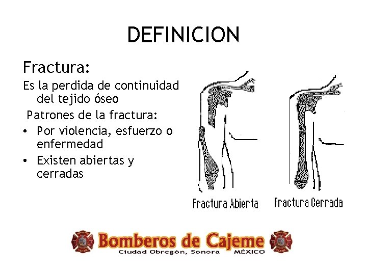 DEFINICION Fractura: Es la perdida de continuidad del tejido óseo Patrones de la fractura: