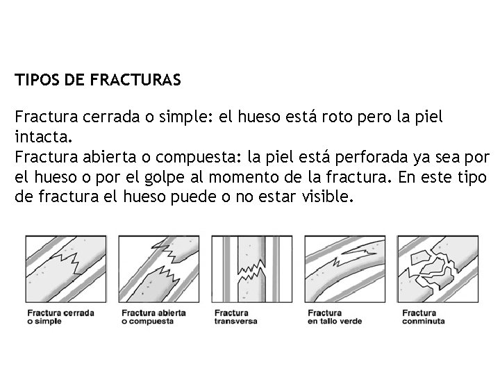 TIPOS DE FRACTURAS Fractura cerrada o simple: el hueso está roto pero la piel