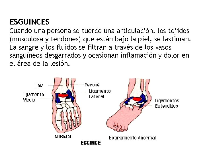 ESGUINCES Cuando una persona se tuerce una articulación, los tejidos (musculosa y tendones) que