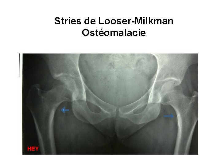 Stries de Looser-Milkman Ostéomalacie HEY 