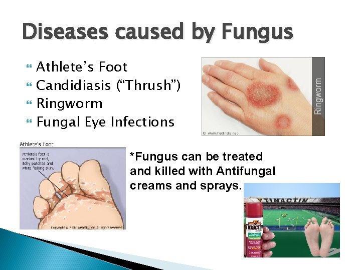 Diseases caused by Fungus Athlete’s Foot Candidiasis (“Thrush”) Ringworm Fungal Eye Infections *Fungus can