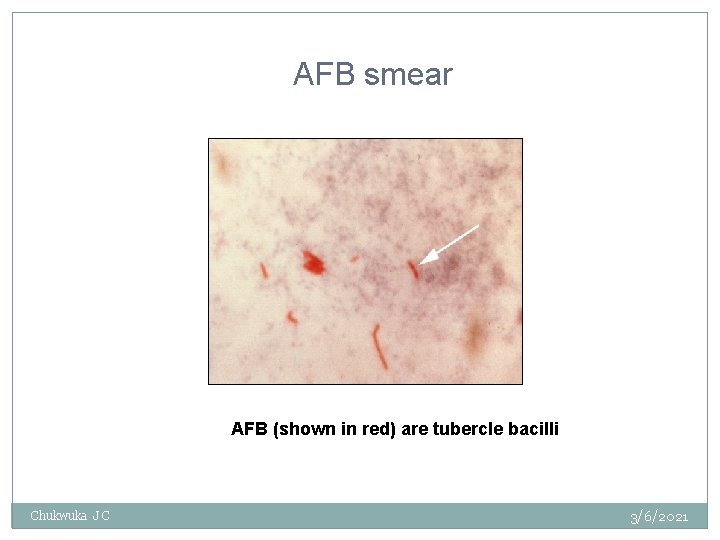 AFB smear AFB (shown in red) are tubercle bacilli Chukwuka J C 3/6/2021 